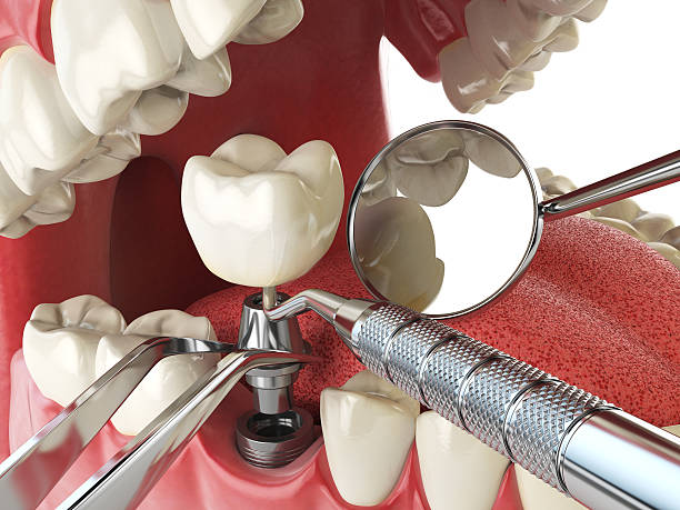 Best Emergency Dental Care for Broken or Chipped Teeth in Perry Heights, OH